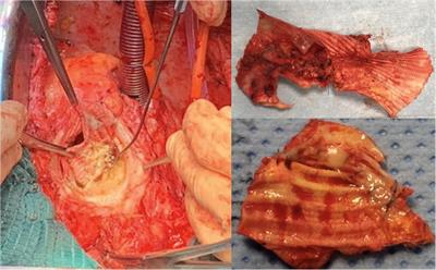 BioGlue® is not associated with polypropylene suture breakage after aortic surgery